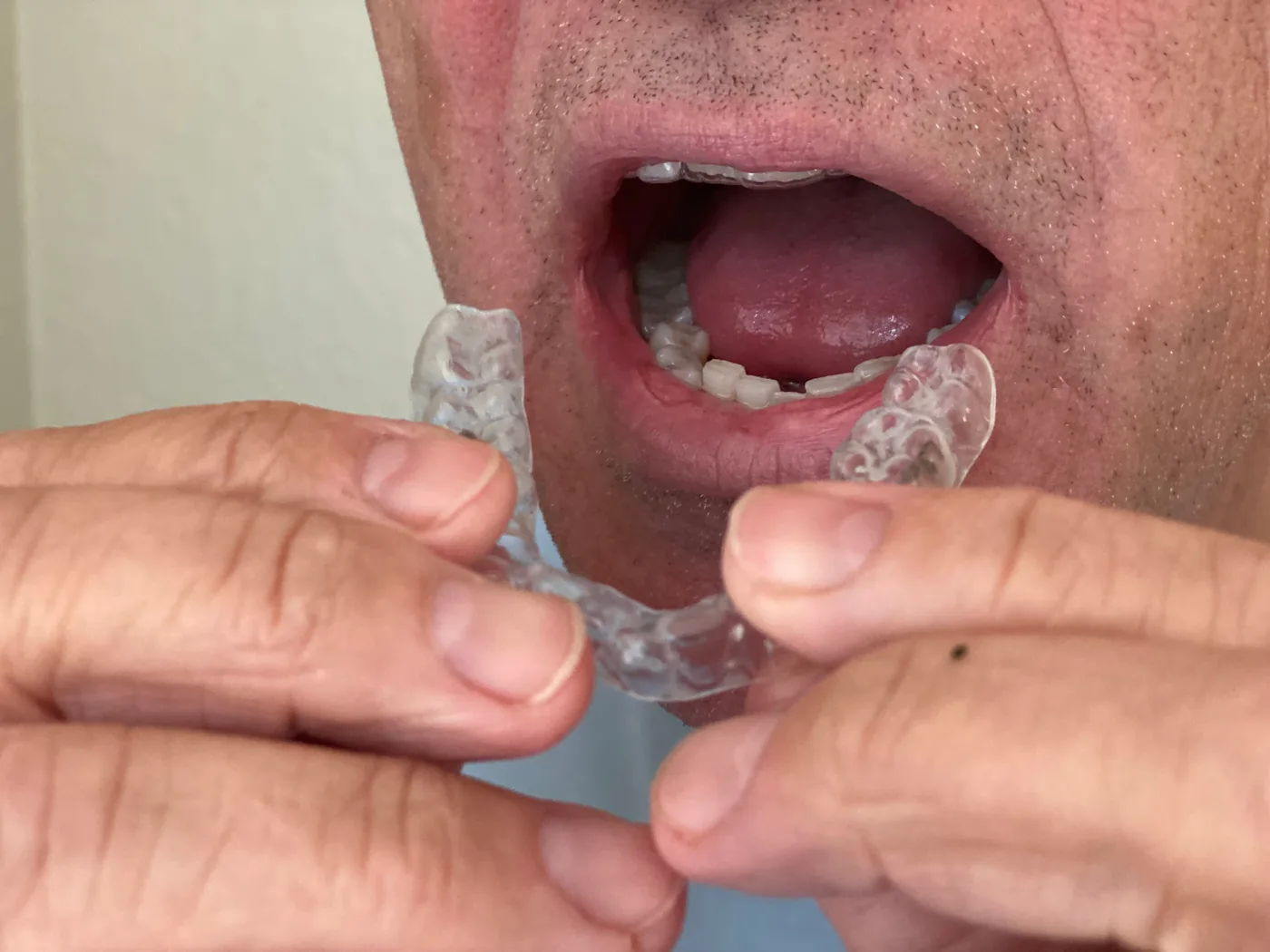 Bruxismo e bite notturno: cause, sintomi e soluzioni