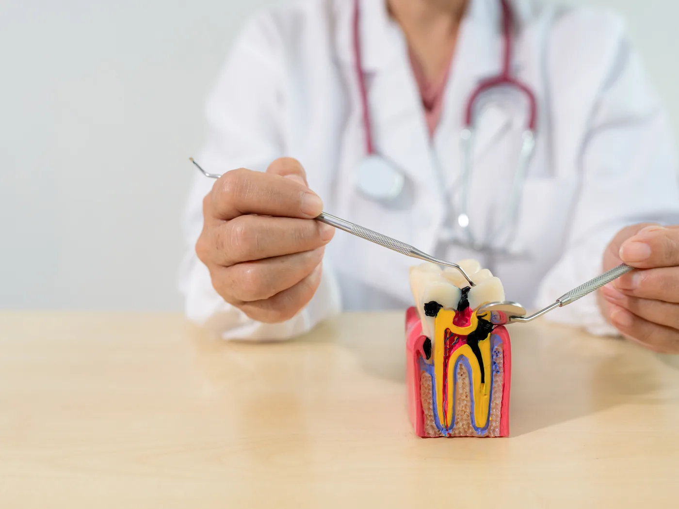 Devitalizzazione dentale: terapia canalare
