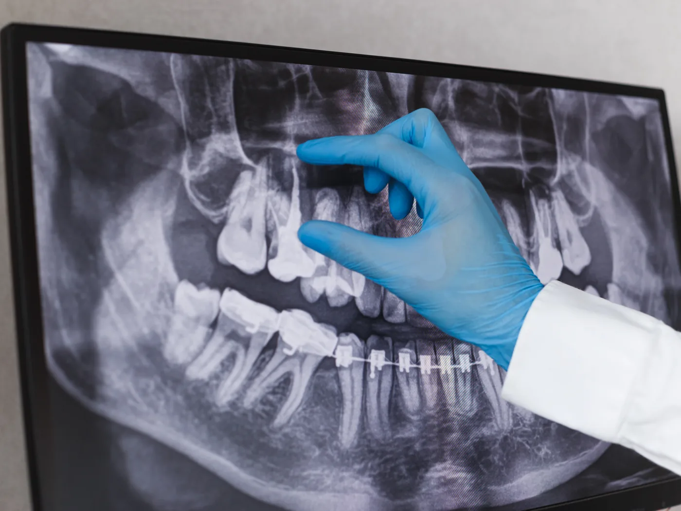 Estrazione del dente del giudizio: quando serve e come si svolge