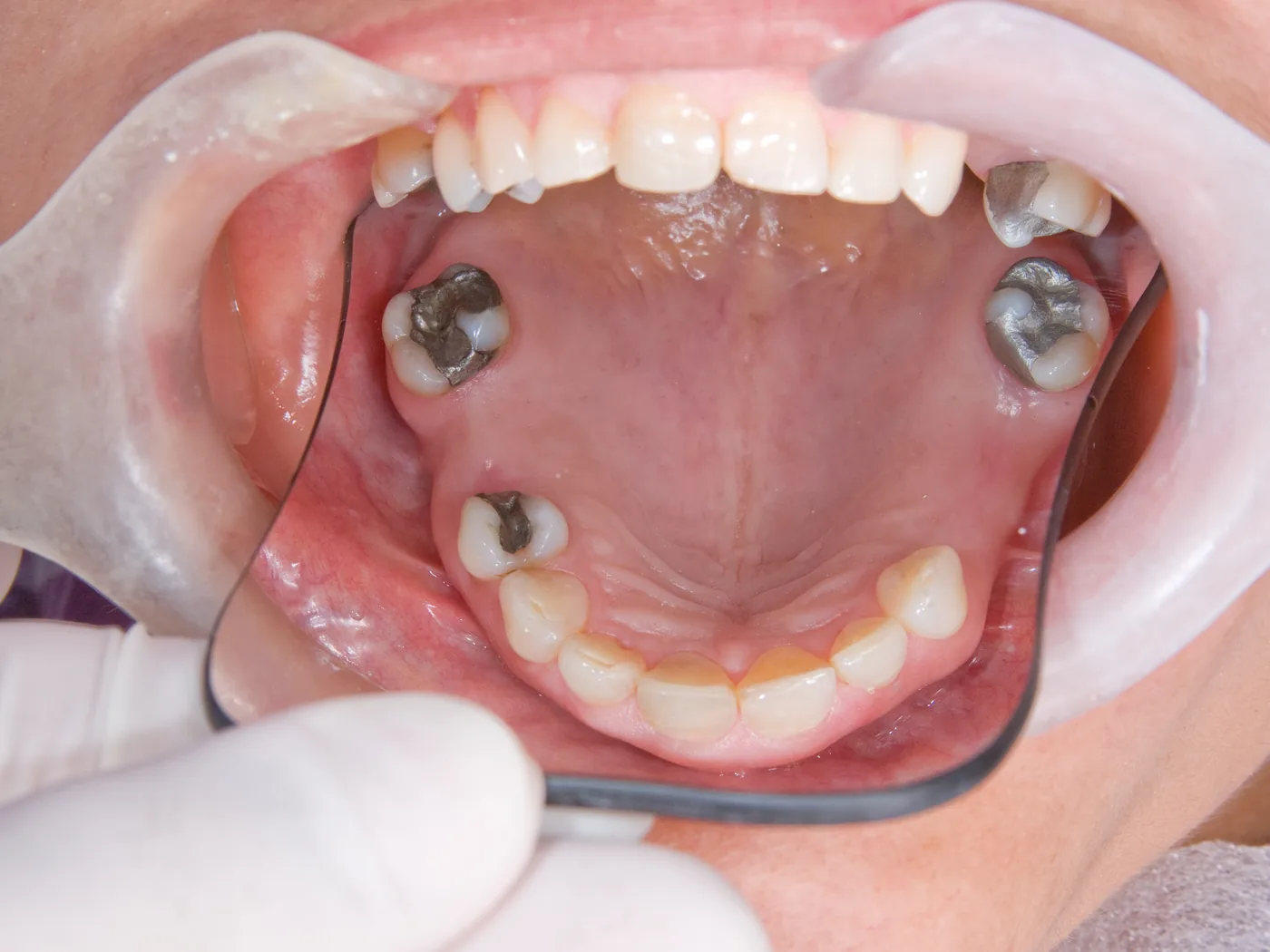 Protesi overdenture su impianti dentali
